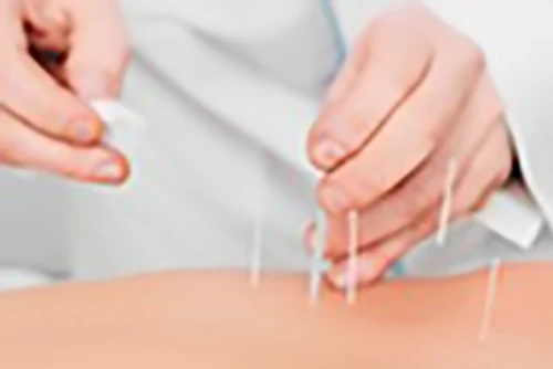 Acupuncture